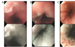实验性人工智能方法提升医生诊断食道癌和癌前病变的能力